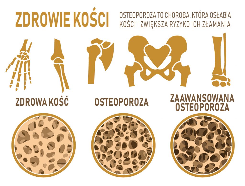 Leczenie osteoporozy